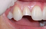 Состояние зубов пациента до реставрации