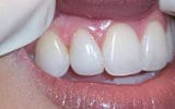 Состояние зубов после реставрации